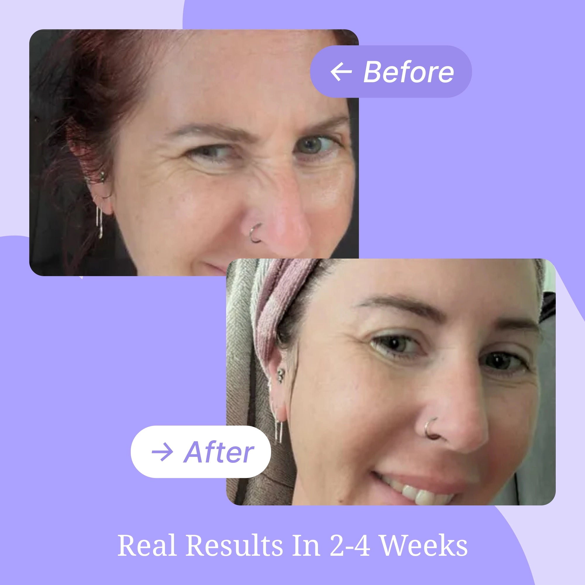 Eyes & Smile Wrinkle Patches