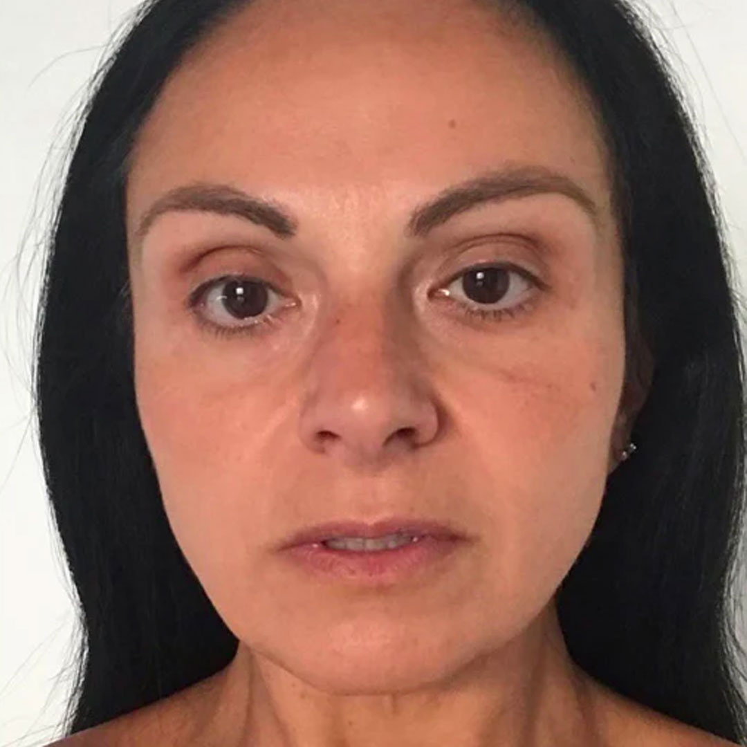 Before After Slider SoSmooth Skincare