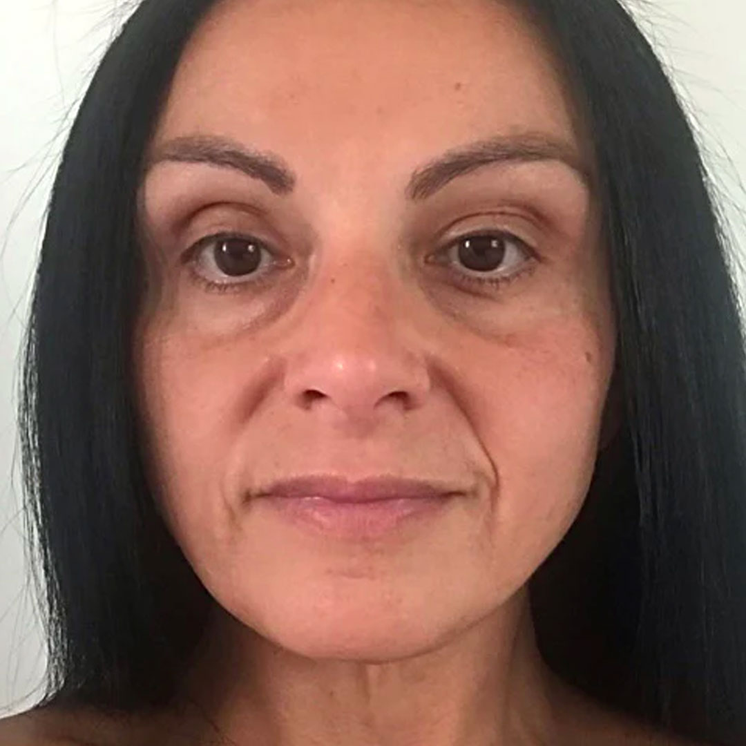 Before After Slider SoSmooth Skincare